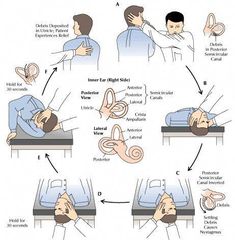 Benign paroxysmal positional vertigo (BPPV) is one of the most common causes of vertigo â€” the sudden of head movements casing momentary vertigo or giddiness Epley Maneuver, Vertigo Exercises, Psoas Release, Rehabilitation Exercises, Medical Help, Physical Therapist, Occupational Therapy, Head And Neck, Massage Therapy