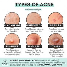 Amazon.com: skin care routine Skincare For Combination Skin, Different Types Of Acne, Haut Routine, Skin Facts, Skin Advice, Clear Healthy Skin, Types Of Acne, Basic Skin Care Routine, Healthy Skin Tips