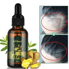 ALL SMART DEALS Aceite Tratamiento Para La Caidad Del Pelo Cabello Calvicie Anticaida Capilar Crecimiento capilar Aceites esenciales Jengibre Aceite germinal Crecimiento capilar rápido Pérdida anticaída Tratamiento de alopecia Suero de crecimiento capilar denso en belleza Especificaciones: Nombre: aceite de crecimiento de cabello de jengibre Contenido neto: 30 ml Ingredientes:  jengibre, ginseng, festival loca, raíz de flor de vellón, aceite de semilla de uva.   Caracteristicas: * El a Regrow Ginger, Ginger Hair Growth, Essential Oil Hair Growth, Fast Hair Growth, Hair Growth Secrets, Fast Hair, Ginger Essential Oil, Regrow Hair, Hair Growth Serum