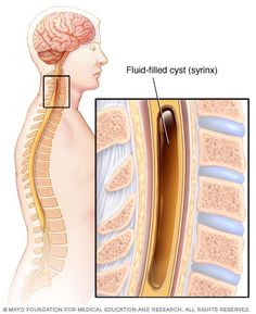 Syringomyelia cyst (syrinx) in the spinal cord - Mayo Clinic Syringomyelia Awareness, Spinal Column, Spinal Injury, Spine Health, Muscle Weakness, Nerve Damage