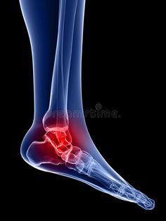 Foot Reflexology Massage, Foot Anatomy, Broken Ankle, Running Injuries, Ankle Pain, Foot Injury, Foot Reflexology, Ankle Injury