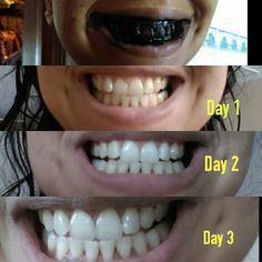 Activated Charcoal Teeth Whitening, Healthy Mouth, Teeth Whitening Homemade, Active Charcoal, Whitening Strips, Whitening Teeth, Charcoal Teeth Whitening