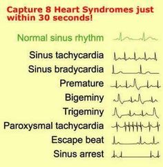 Heart syndromes. Check out Nurses Rock! on Facebook for more! www.facebook.com/1nursesrock Certified Medical Assistant, Learning Logo, Nursing Tips, Future Nurse, Nursing Study, Nursing Notes