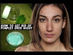 Almost every nightmare is having pimple on face and we all put our all efforts to get rid of these pimples and get back clear skin. In this video you will se... Under The Skin Pimples, Pimple On Face, Natural Remedies For Acne, Pimples On Forehead, Small Pimples, Remove Blackheads From Nose, Remedies For Acne, Increase Height Exercise