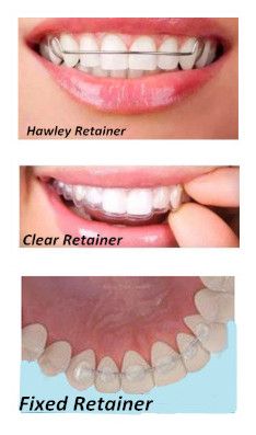 Metal Retainers For Teeth, Clear Retainers After Braces, Retainers For Teeth, Retainers After Braces, Braces Removal, Teeth Types, Teeth After Braces, Braces Journey