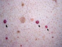 Cherry Angiomas - Find the real cause: bromine toxicity & idodine deficiency! Pineapple Health Benefits, Red Moles, Magnesium Supplement, Epson Salt, Toenail Fungus Remedies, Home Remedies For Skin, Salt Bath, Cleaning Painted Walls