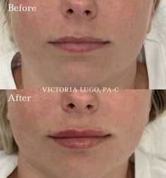 lip filler before and after Half Syringe Lip Filler Before And After, Lip Filler Before And After, Lip Injections, Beauty Stuff, Body Inspiration, Natural Lips, Natural Makeup