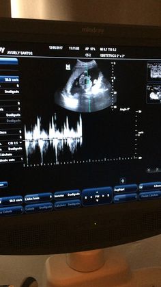 a computer monitor with an x - ray image on it's screen and sound waves