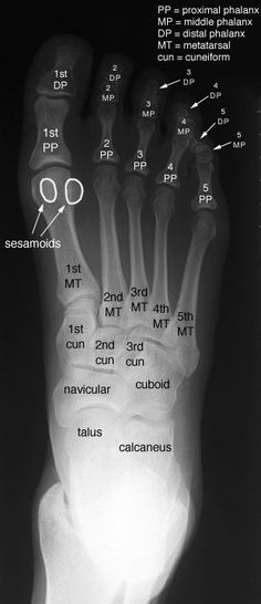 an x - ray view of the foot and bones showing different types of metataximals