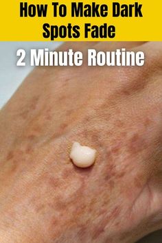 Diy Anti Aging Cream, Age Spots On Face, Diy Anti Aging, Dry Skin Remedies, Skin Care Wrinkles