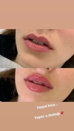 Lip Fillers Round, Lip Injections Heart Shape, Deep Cupids Bow Lips, Bigger Bottom Lip Filler, Lip Filler Shape Ideas Pouty, Asian Lip Filler, Round Lips Filler, Lip Inspo Filler, Lip Fillers Before And After