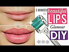 Lips Hack, Make Lips Bigger, Bigger Lips, Castor Oil For Skin, Spotless Skin, Fuller Lips, How To Get Bigger, Get Rid Of Acne