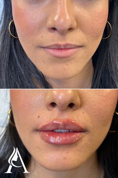 Lips before and after - we're OBSESSED with this first-time lip filler transformation!

Restylane Kysse lip filler in Philadelphia, PA. 

Book a consultation with our amazing injectors at Ari Blanc Medical Spa for your own lip makeover! Lip Fillers Juvederm, Saggy Cheeks, Restylane Lips, Cupids Bow Lips, Hyaluronic Acid Lips