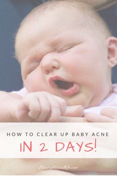 These two products worked like magic to clear up my daughter's baby acne. Aveeno Baby, Face Mapping, Blessed Life, Baby Care, Parenting Hacks, Baby Love