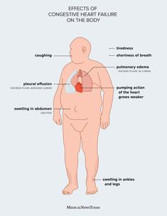 Congestive heart failure: Symptoms, treatment, and more Fluid In Lungs, Pleural Effusion, Heart Defect, Atrial Fibrillation, Heart Rhythms, Heart Pump, Heart Muscle, Shortness Of Breath, Better Health