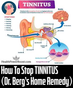 How to Stop Tinnitus (Ringing in The Ears)? – Try Dr. Berg's Home Remedy to Get Rid of It #Remedies