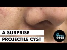 Click here to subscribe to Dr. Pimple Popper: https://www.youtube.com/@DrPimplePopper/Join All Access Memberships here:https://www.youtube.com/channel/UCgrsF... Head Pimples, Pimple Popper Tool, Zits Popping, Healthy Life Hacks, Workout For Flat Stomach, Laser Therapy, How To Get Rid Of Acne