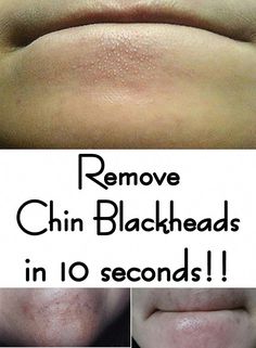 Interesting Stories From All Over The World Chin Blackheads, Rid Of Blackheads, Natural Hair Mask, Cow Milk, Remove Hair, Acne Scar Removal, Baking Soda Shampoo, Smoother Skin