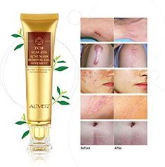 Acne Mark Removal, Stretch Mark Removal Cream, Skin Repair Cream, Effaclar Duo, Scar Removal Cream, Stretch Mark Cream, Stretch Mark Removal