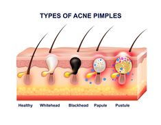 Different Types Of Acne, How To Clear Pimples, Forehead Acne, Pimples Under The Skin, Skin Facts, Types Of Acne, How To Get Rid Of Acne, Skin Cleanser Products