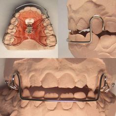 Dental Assistant Study, Dental Hygiene Student, Orthodontic Appliances, Dental Aesthetics, Dental Anatomy, Dental Technician, Dental Facts, Dental Laboratory