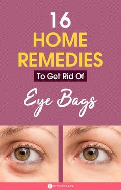 Eye Bag Remedies, Puffy Eyes Remedy, Baggy Eyes, Droopy Eyelids, Cucumber Slices, Under Eye Puffiness