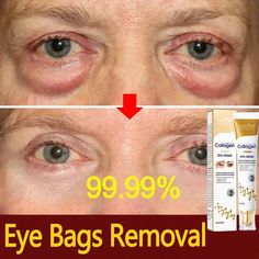 Product updates, new and old products are randomly shipped ������If you need a larger discount. You can click on the image below. Buy 5 get 5 free!!!�� Instant Eye Bag Removal Cream Collagen Removal Wrinkles Firming Skin Fade Fine Lines Anti-Aging Anti Puffiness Dark Circle Brighten Eye Care Korean ▶Effect:Reduces sign Eye Bag Removal, Remove Eye Bags, Eye Wrinkle Cream, Firming Skin, Cells Activity, Skin Fade, Remove Dark Circles, Eye Brightener, Face Lines