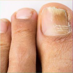 Toenail Fungus Treatment: 3 Steps to Get Rid of It Fast! Yellow Toe Nails, Toenail Fungus Remedies, Nail Fungus Remedy, Nail Infection, Fungal Nail, Ingrown Toe Nail, Toenail Fungus, Lifestyle Habits, Fungal Infection