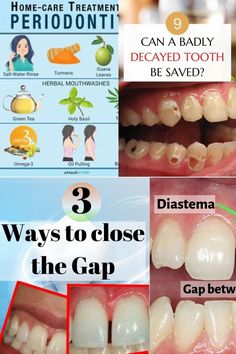 Learn about some adjunct home therapies and self-care tips for periodontitis to go along with your standard prescribed treatment. Receding Gums, Care Tips, Home Remedies, Self Care, Health, Quick Saves