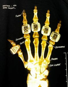 an x - ray image of the hand and wrist with different types of medical devices