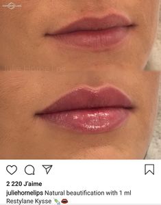 Lip Fillers Juvederm, Lip Fillers Shapes, Lip Job, Lips Fillers, Lips Shape, Permanente Make-up