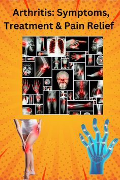 Here we take a closer look at the 2 most common types of arthritis osteo-arthritis and rheumatoid arthritis. Common treatments used to treat these types of arthritis. Treatments used to help with pain relief. Learn more about arthritis here. If you find the information helpful, please like the video and subscribe to the channel for more helpful information. Thank You! ‪@WellnessWisdomGuide1‬ Pain Medicine, Reduce Inflammation, Pain Relief, Natural Remedies, Take A, Medicine, Look At