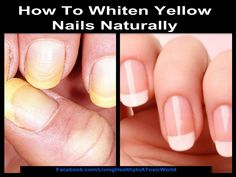 Make Nails White, Yellow Toe Nails, Stained Nails, Nail Whitening, Nail Base Coat, Yellow Nails Design, Living Healthy, Nail Fungus