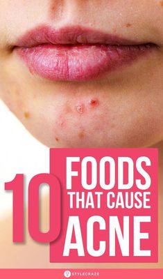 Though food alone cannot cause acne, certain foods can worsen the existing condition. Here are the foods that cause acne to worsen and foods for clear skin. Acne Causing Foods, Foods For Clear Skin, Bad Acne, Hormonal Imbalance, Acne Skincare Routine, Natural Acne, Acne Causes