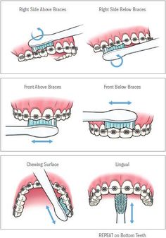 Dental Braces Colors, Braces Food, Cute Braces Colors, Braces Tips, Getting Braces, Cute Braces, Kedokteran Gigi, Brace Face