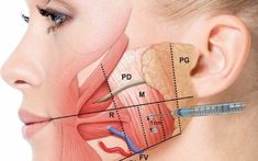 Botox Masseter, Teeth Clenching, Clostridium Botulinum