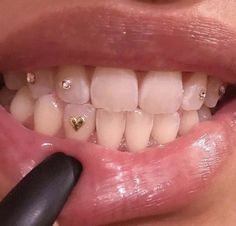 a close up of a person's mouth with braces on it and a black pen in front of them