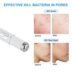 Skin Spot Remover, Acne Laser, Blue Light Therapy, Tighten Loose Skin, Acne Removal, Skin Spots, Acne Spots, Remove Acne, Loose Skin