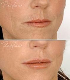 Restylane Lip Definition Before After Lip Pump, Botox Alternative, Old Skin, 20 Year Old, Lip Injections, Skin Hair