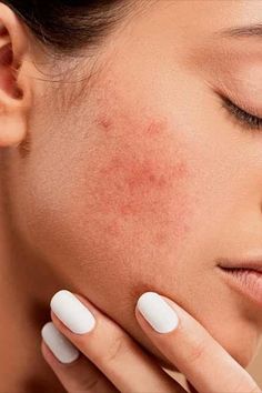 Face Diy Acne | Diy Acne | Face Care Acne | Food That Clear Acne | Skin Care Acne | Diy Face Mask Acne Diy Face Mask, Acne Clearing Foods, The Best Skin Care Routine, Face Care Acne, Face Diy, Skin Aesthetics, Email Marketing Design Inspiration, Diy Acne, Perfect Eyelashes