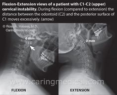 Cervical Lordosis, Vertebral Artery, Spine Health, Cervical Spine, Stem Cell Therapy, Neck Pain Relief, Vagus Nerve, Ehlers Danlos, Hip Pain