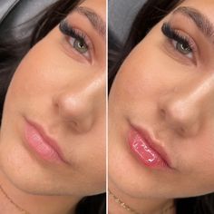 0.5ml Lip Filler Before And After, 0.5 Ml Lip Filler Before And After, Lip Augmentation