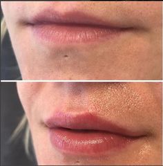 Facial Balancing, Lip Flip, Facial Fillers, Makeup Makeover, Dermal Fillers, Lip Fillers, Skin Care Women