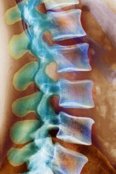 an x - ray image of the back of a person's neck