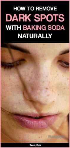 Sun Spots On Skin, Spots On Forehead, Brown Spots On Hands, Heart Diet