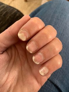 Onycholysis - NailKnowledge Toenail Health, Fingernail Fungus, Nail Conditions, Nail Coat, Nail Problems, Nail Fungus Remedy, Nail Infection, Fungal Nail, Toenail Fungus