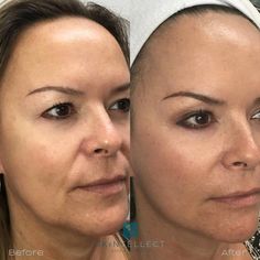 Fotona 4D Skin Tightening offers a non-surgical, non-invasive facelift alternative that delivers natural-looking, long-lasting results... Laser Skin Tightening, Nose Picking, Skin Tightening, Facial, Long Lasting, Skin, Hair