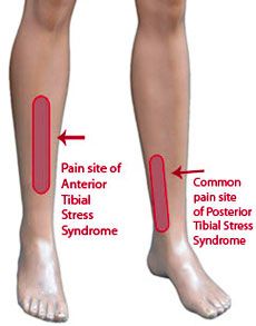 Lower Leg Pain, Small Wave Tattoo, Runner Problems, Running Injuries, Knee Exercises, Leg Pain