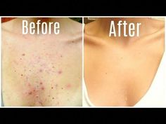 Dermatologist-approved methods for banishing chest acneWhen summertime rolls around and you want to wear your favorite tank or new bathing suit, the last thing you want to deal with is chest acne. But you're not alone: many people who have... Arm Acne, Body Acne Remedies, Shoulder Acne, Back Acne Remedies, Pimples Under The Skin, Skin Diet, Bad Acne