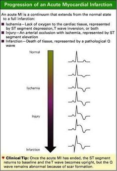 a diagram showing the progression of an acutele myocardial inferction